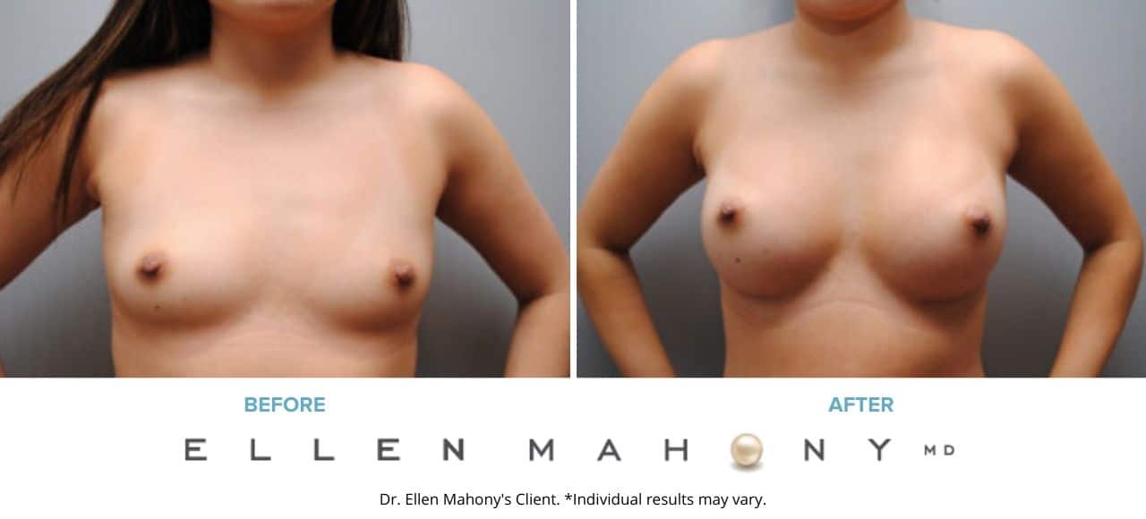 Breast Augmentation | Westport CT | Dr. Ellen Mahony