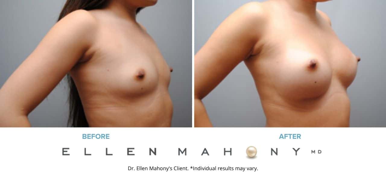 Breast Augmentation | Westport CT | Dr. Ellen Mahony