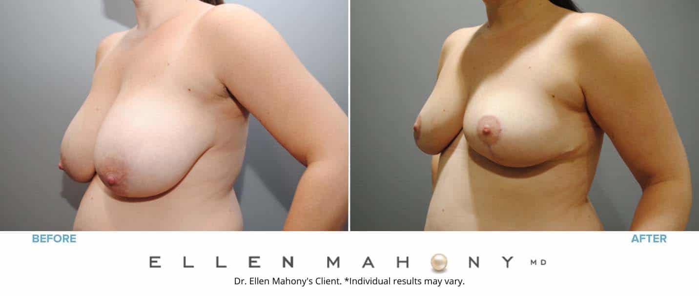 Breast Reduction | Westport CT | Dr. Ellen Mahony