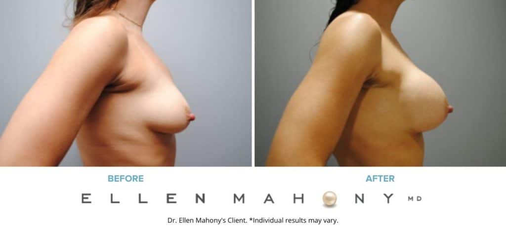 Breast Augmentation | Westport CT | Dr. Ellen Mahony