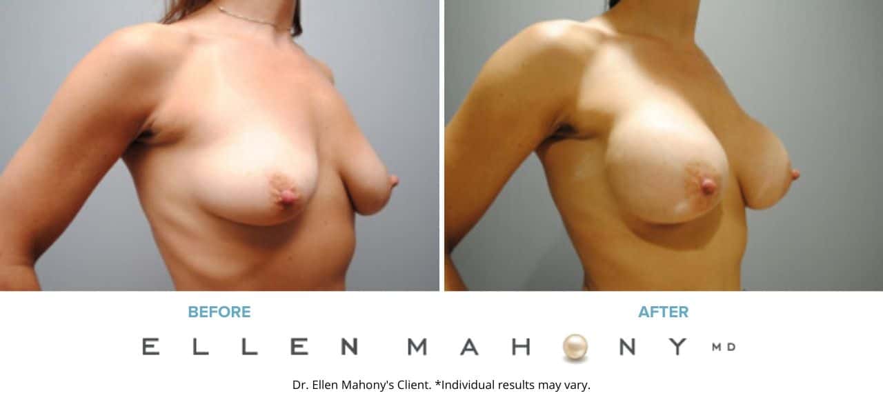 Breast Augmentation | Westport CT | Dr. Ellen Mahony