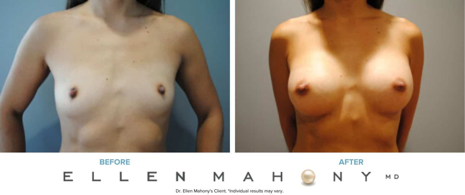 Breast Augmentation | Westport CT | Dr. Ellen Mahony