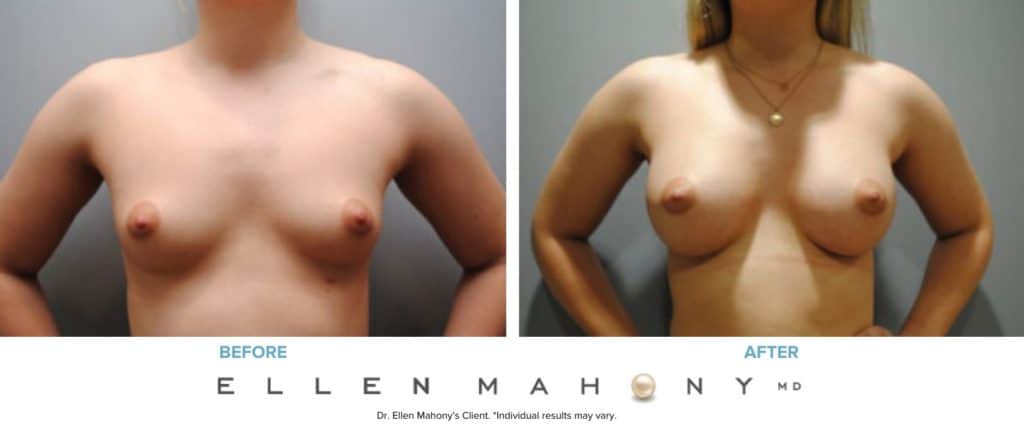 Breast Augmentation | Westport CT | Dr. Ellen Mahony