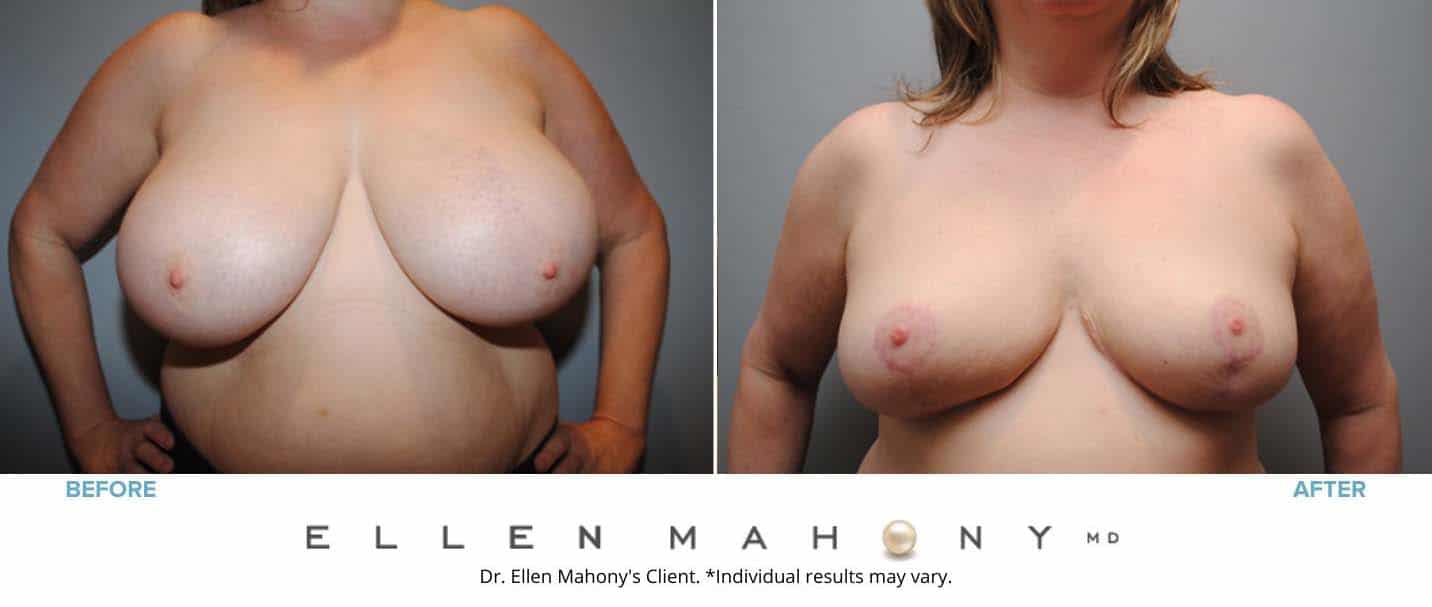 Breast Reduction | Westport CT | Dr. Ellen Mahony