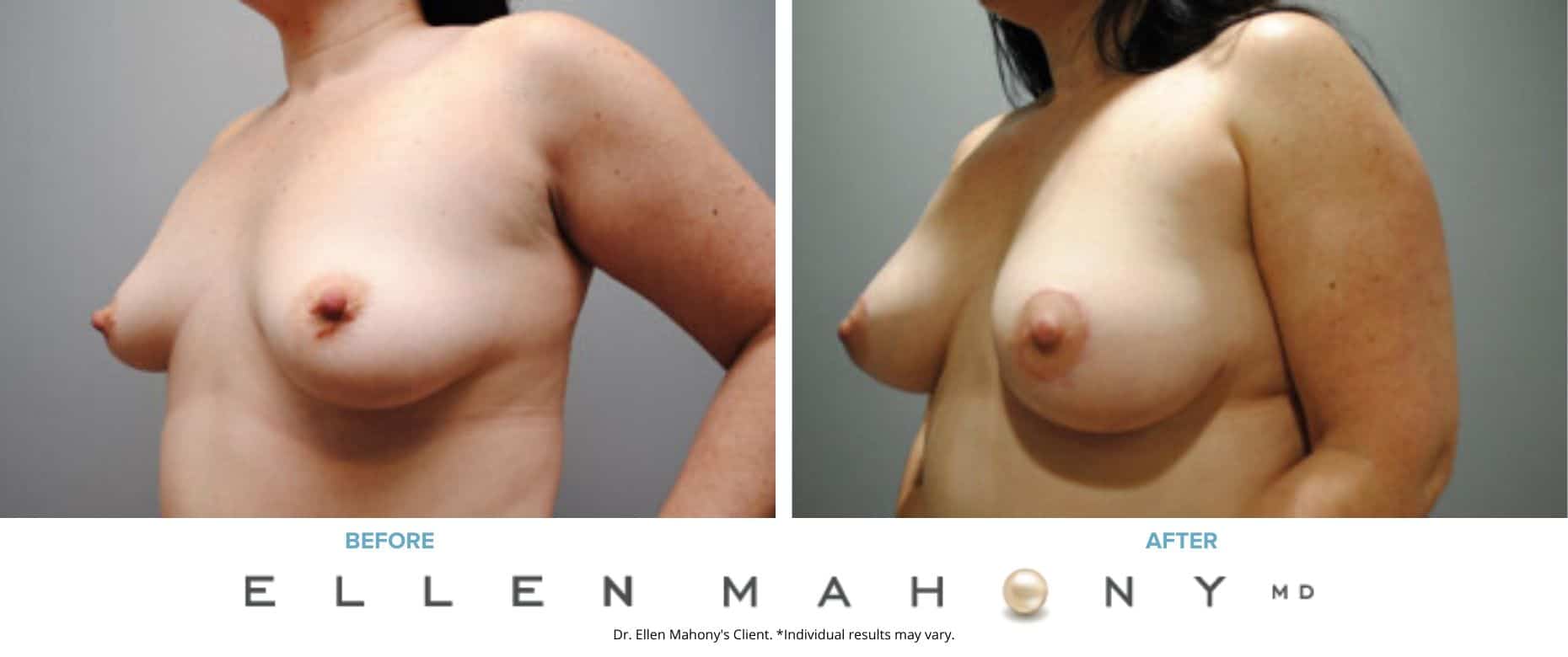 Breast Lift | Westport CT | Dr. Ellen Mahony