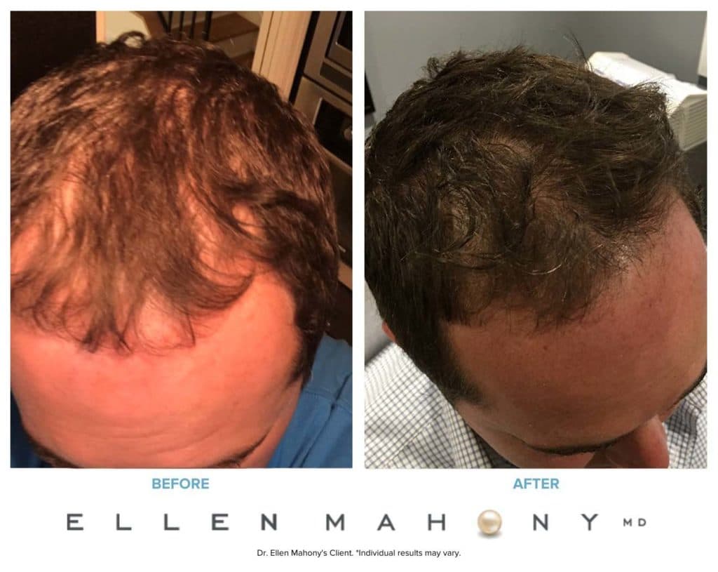 PRP Hair Restoration | Westport CT | Dr. Ellen Mahony