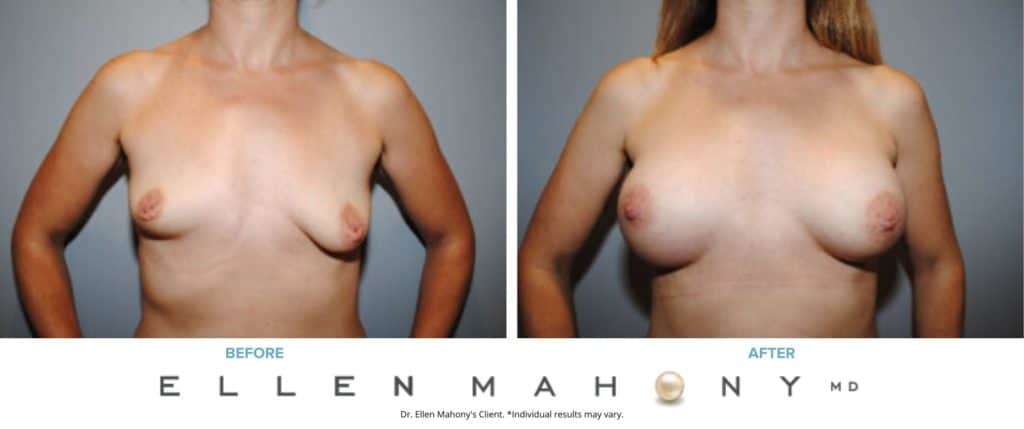 Breast Augmentation and Lift | Westport CT | Dr. Ellen Mahony