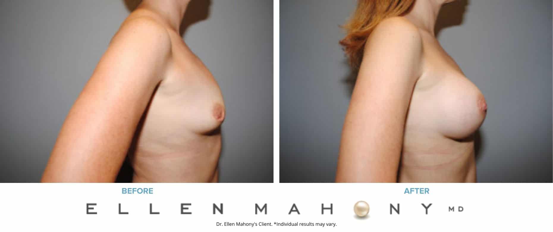 Breast Augmentation and Lift | Westport CT | Dr. Ellen Mahony