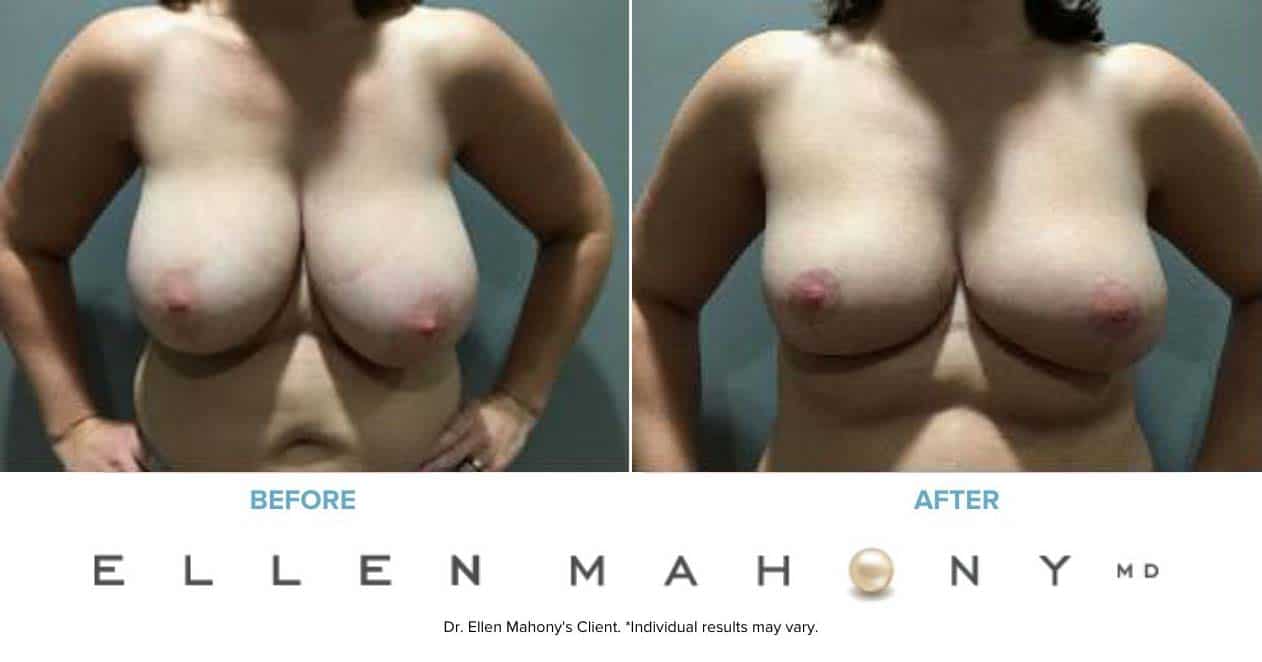 Breast Reduction | Westport CT | Dr. Ellen Mahony