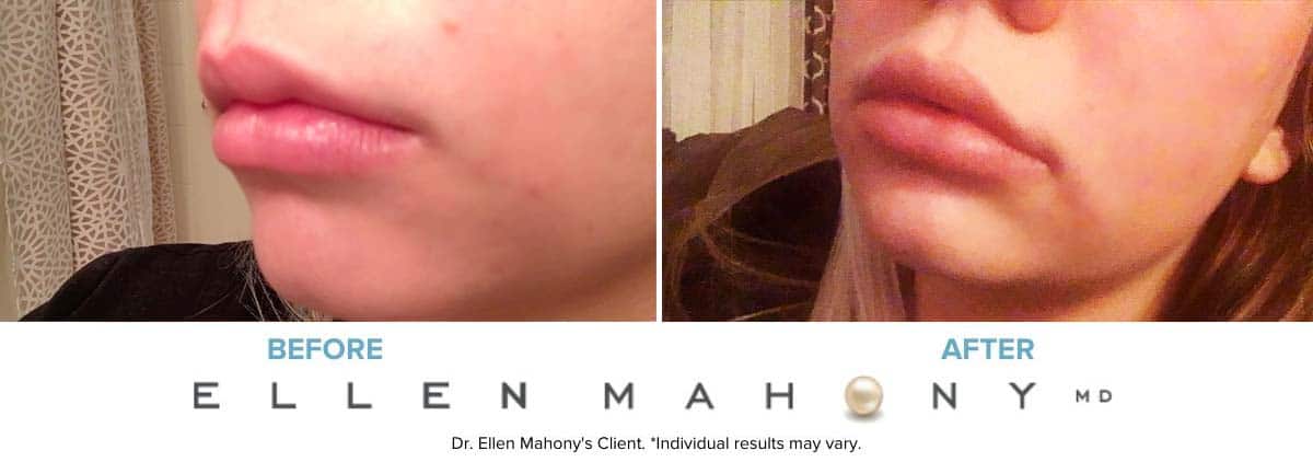 Lip Augmentation | Westport CT | Dr. Ellen Mahony