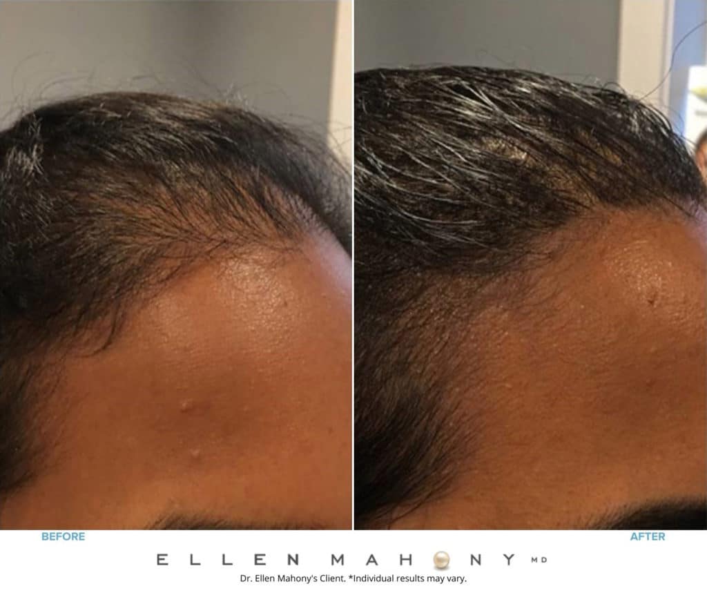 PRP Hair Restoration | Westport CT | Dr. Ellen Mahony