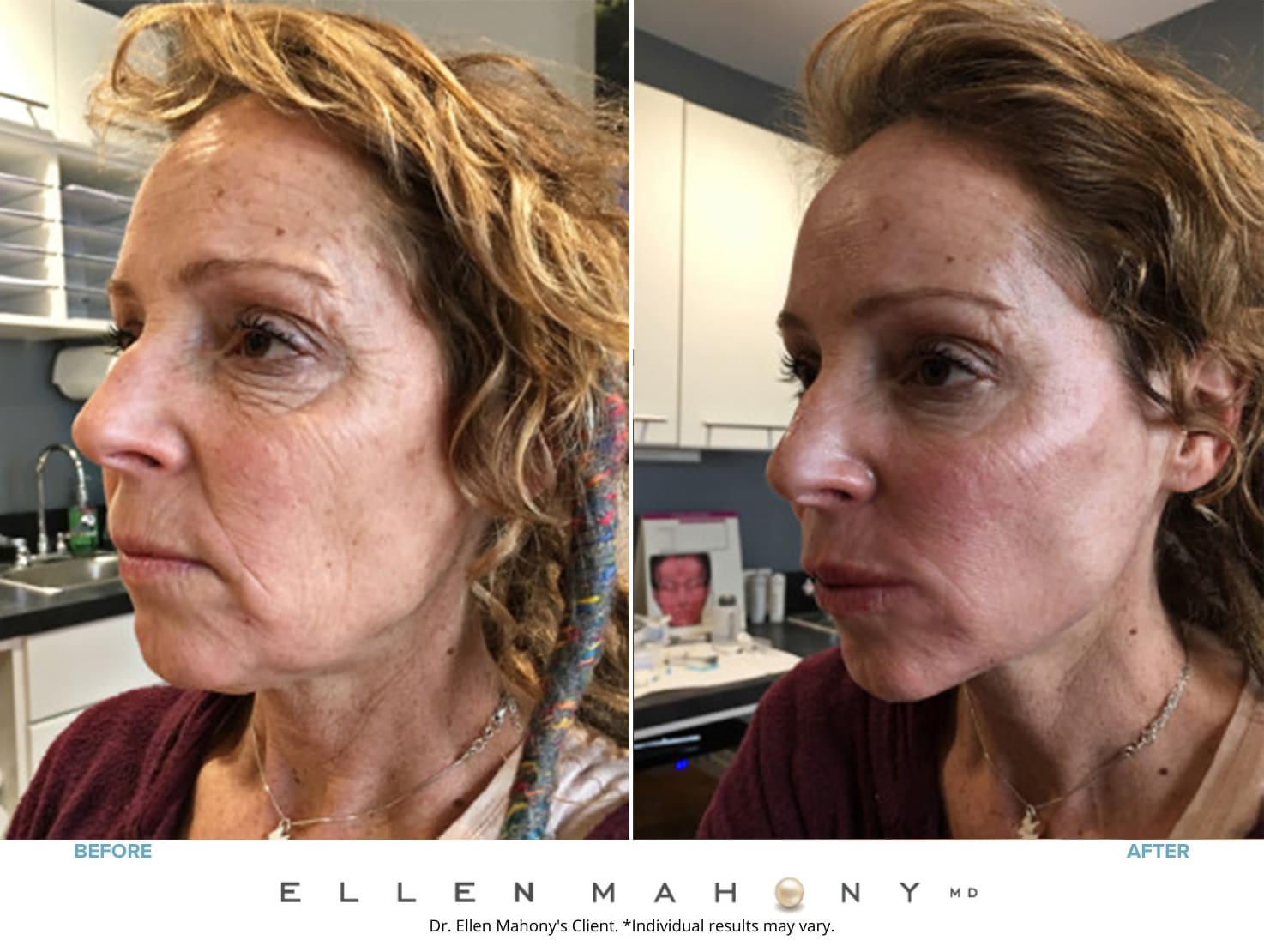 Vampire Facelift | Westport CT | Dr. Ellen Mahony