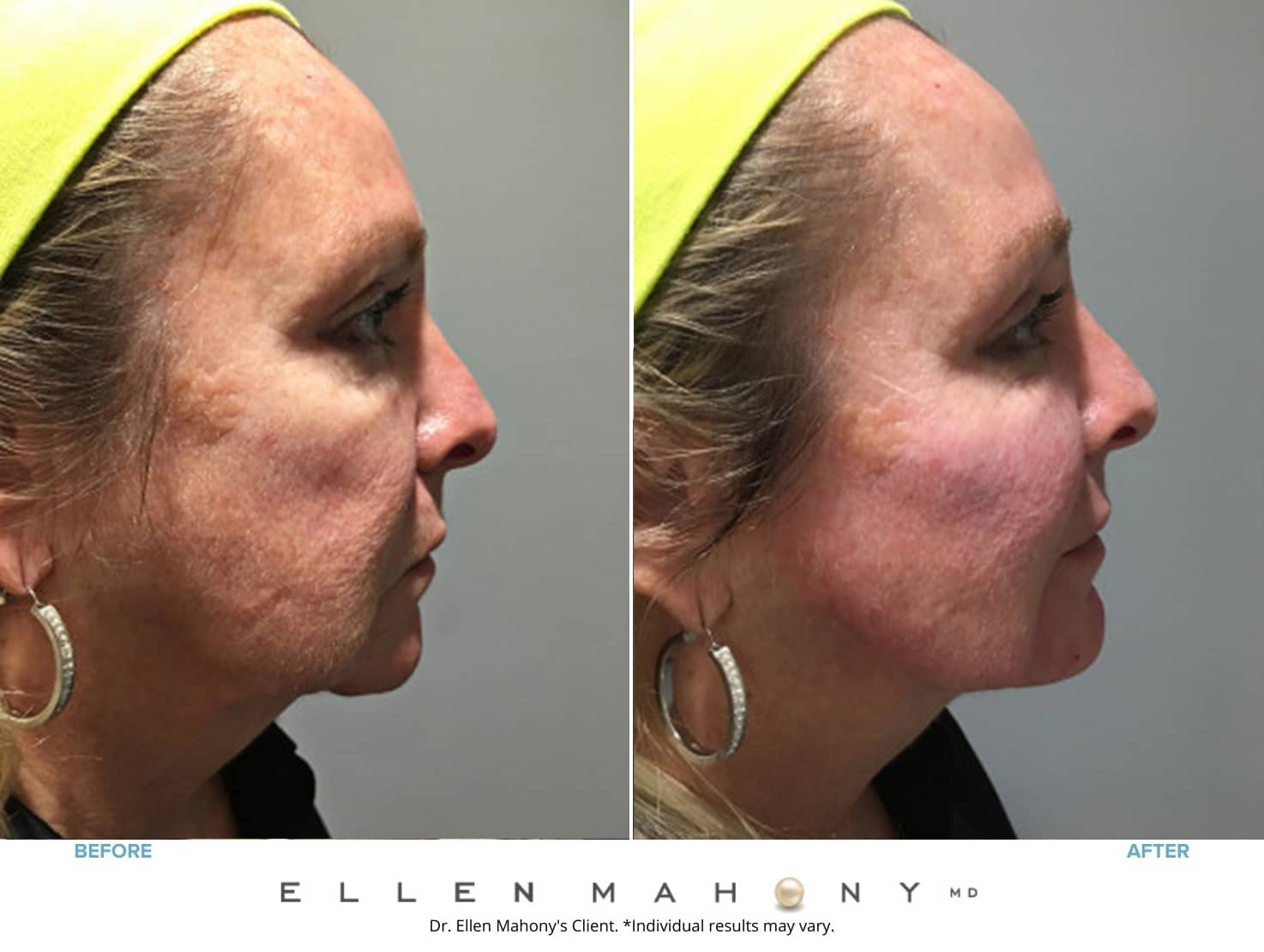 PRP Hair Restoration | Westport CT | Dr. Ellen Mahony