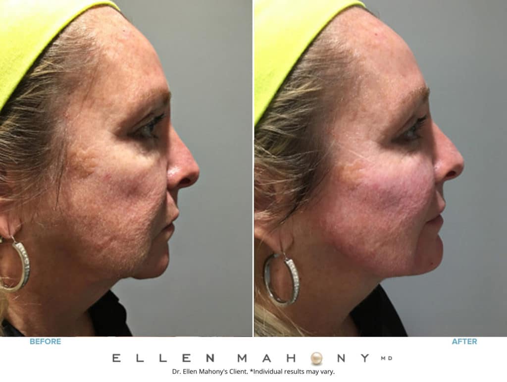 ALMI Regenerative Cell Facelift | Westport CT | Dr. Ellen Mahony