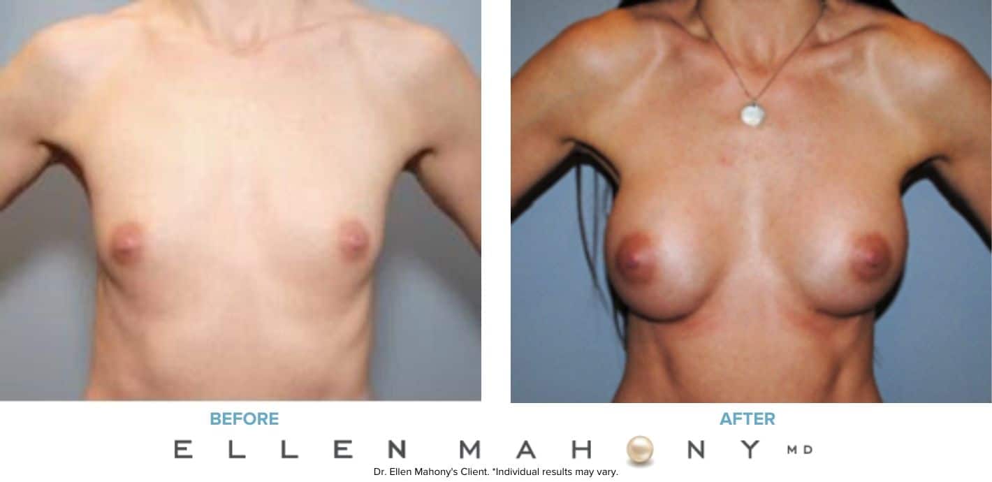 Breast Augmentation | Westport CT | Dr. Ellen Mahony