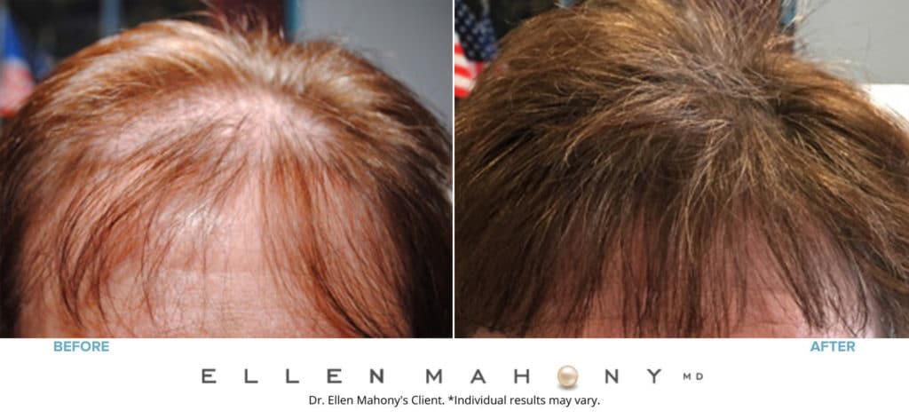 PRP Hair Restoration | Westport CT | Dr. Ellen Mahony