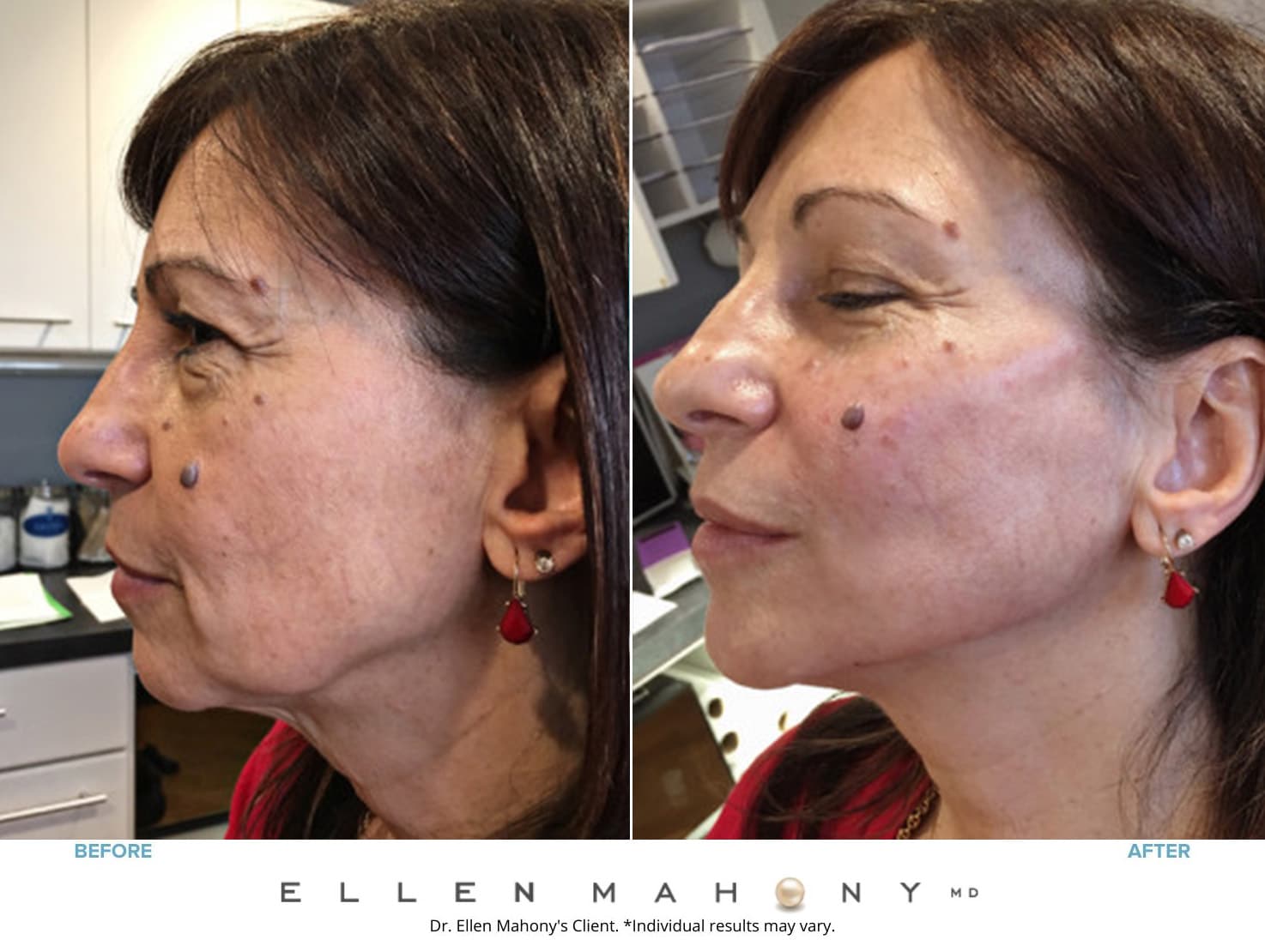 Before & After Image of PRP Vampire Facelift Fairfield County CT