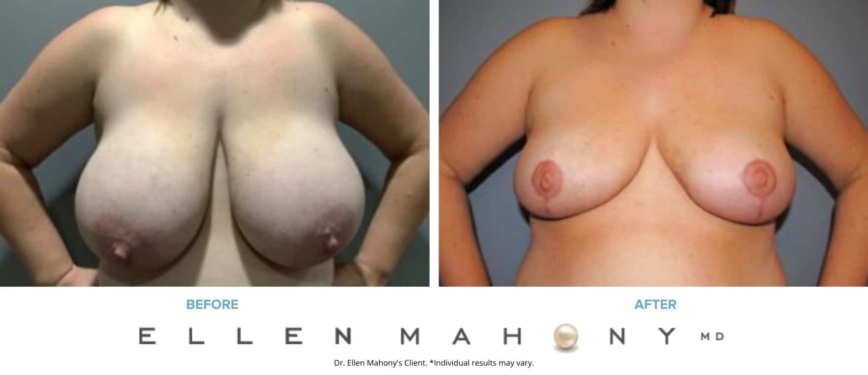 Breast Reduction | Westport CT | Dr. Ellen Mahony