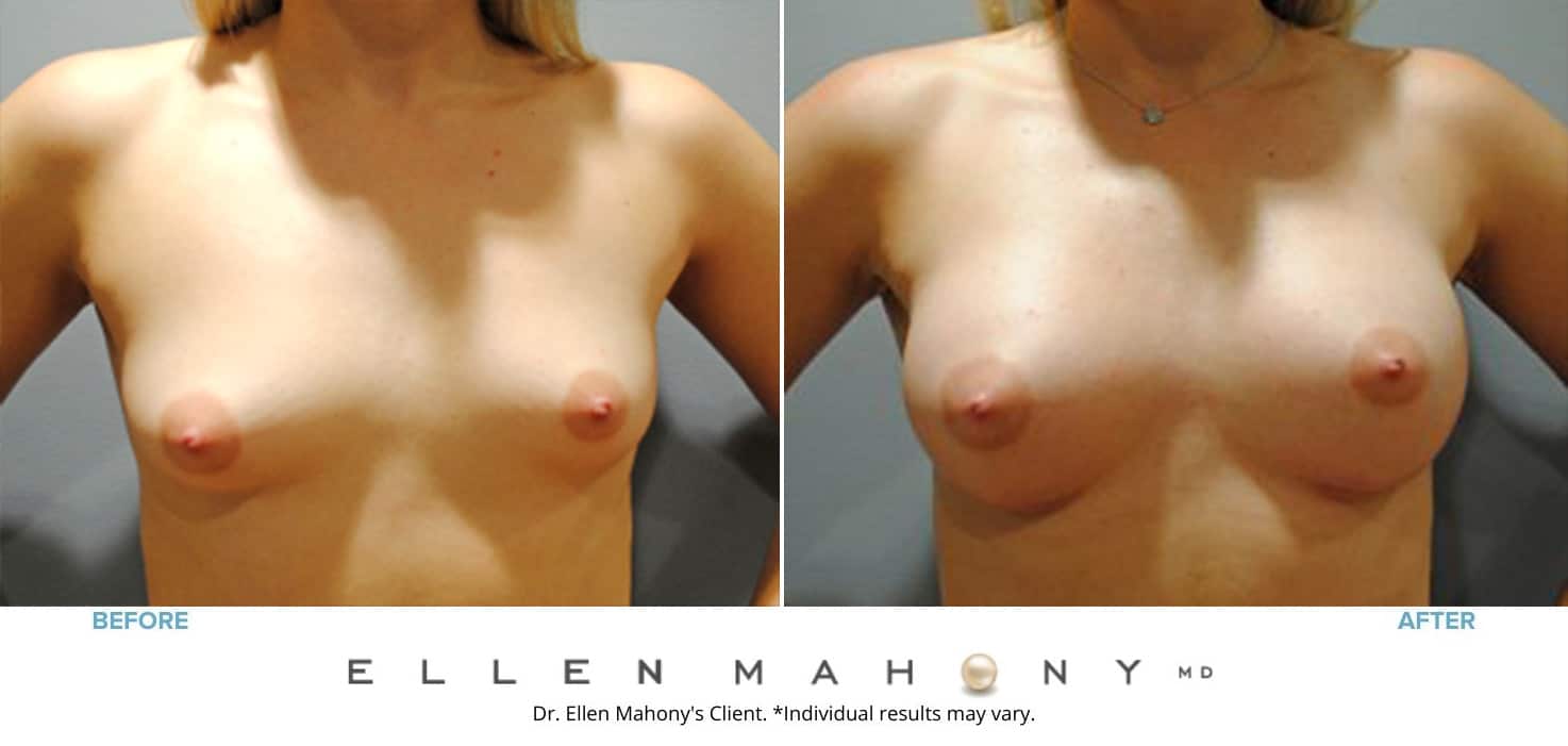 IDEAL Breast Implants | Westport CT | Dr. Ellen Mahony