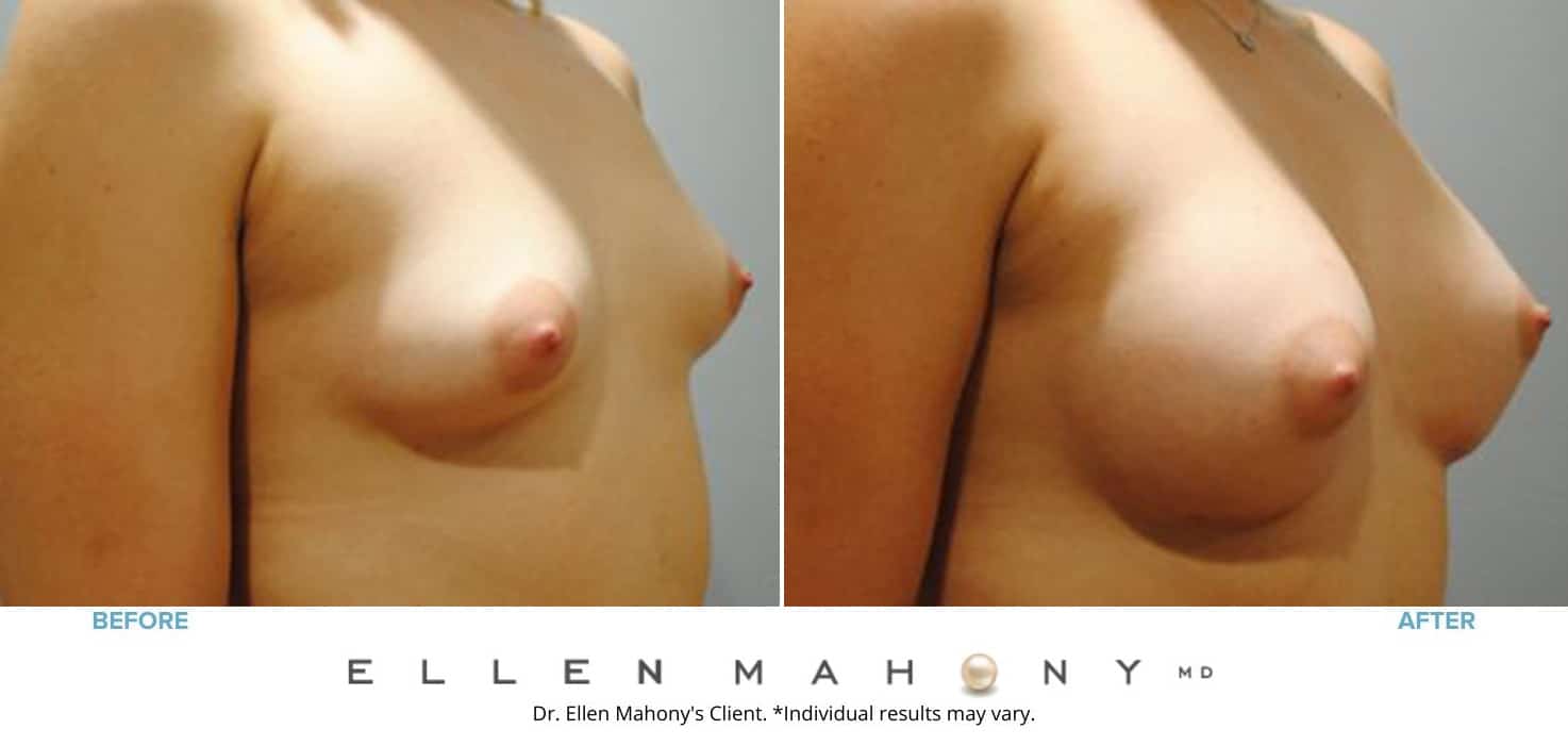 IDEAL Breast Implants | Westport CT | Dr. Ellen Mahony