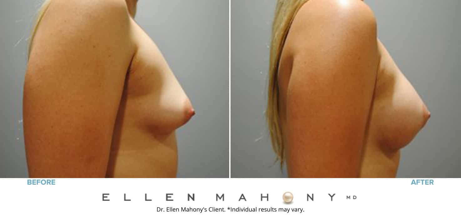 IDEAL Breast Implants | Westport CT | Dr. Ellen Mahony