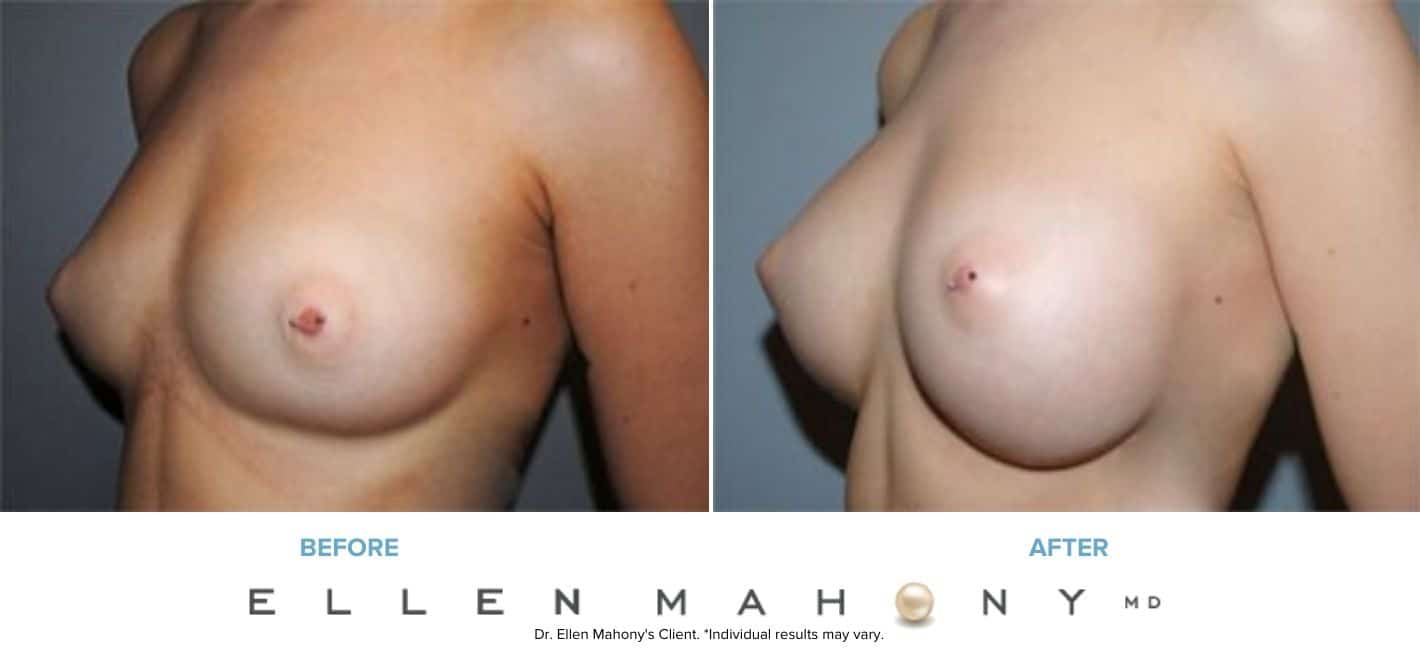 IDEAL Breast Implants | Breast Augmentation | Westport CT | Dr. Ellen Mahony