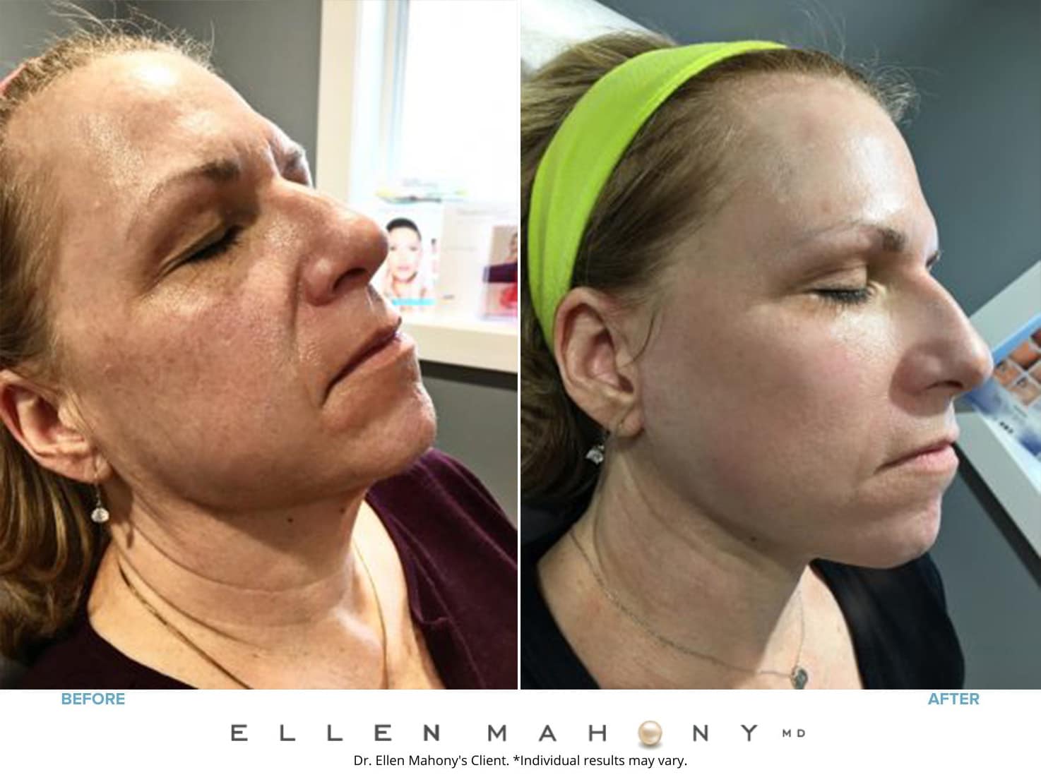 Before & After Image of PRP Vampire Facial Westport CT