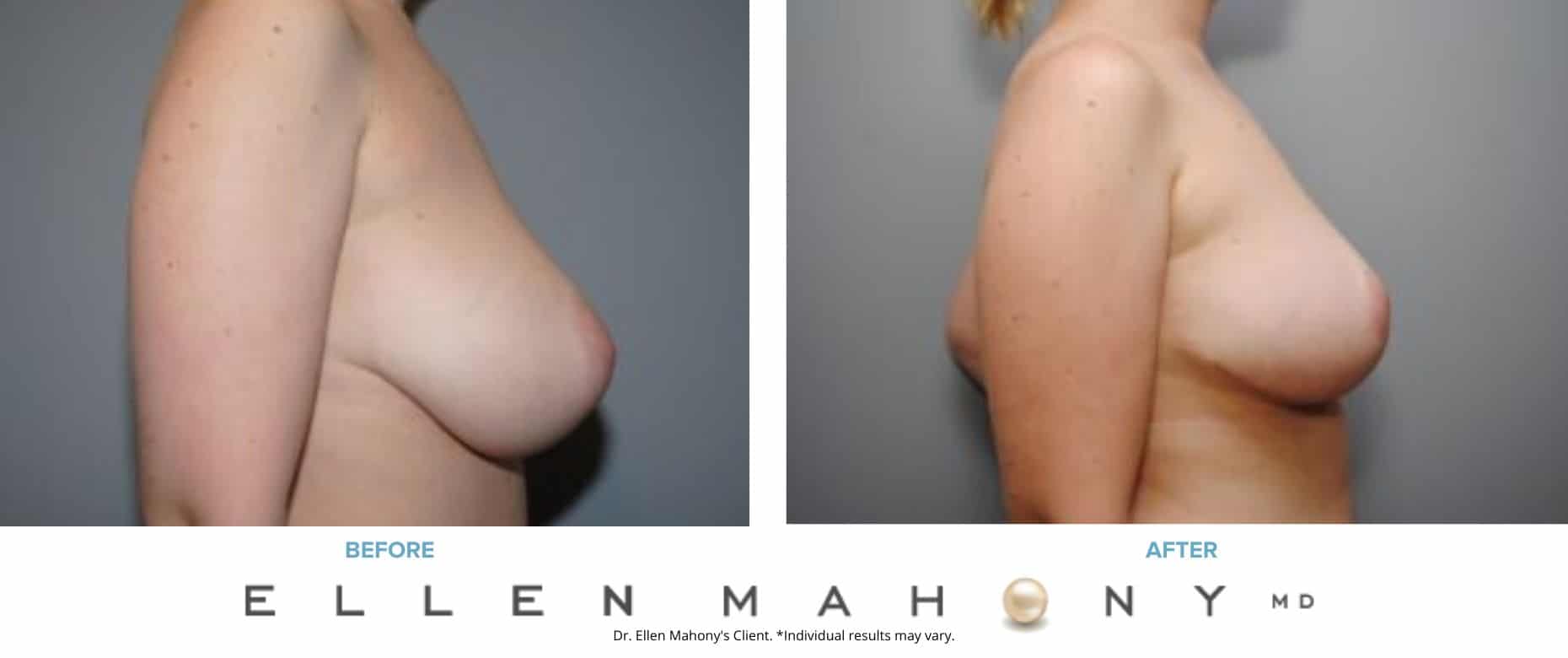 Breast Reduction Before & After Images Fairfield County CT