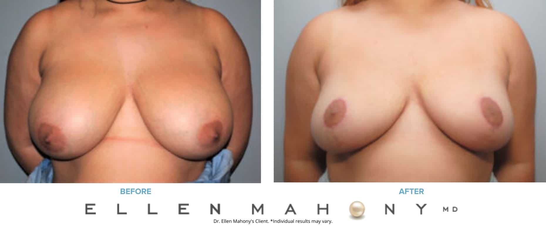 Breast Reduction | Westport CT | Dr. Ellen Mahony