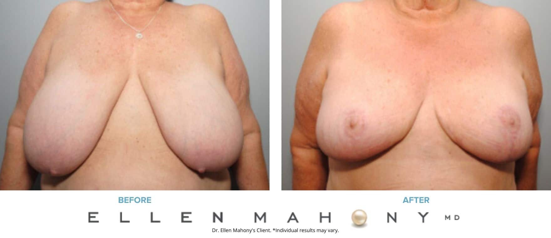 Breast Reduction | Westport CT | Dr. Ellen Mahony