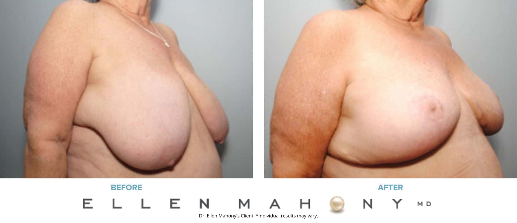 Breast Reduction | Westport CT | Dr. Ellen Mahony