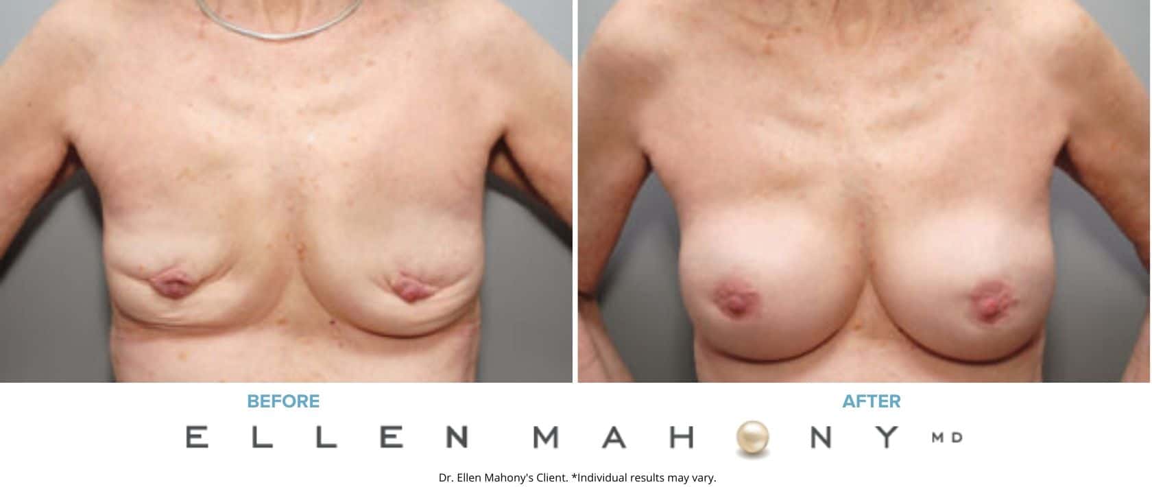 Corrective Breast Surgery Fairfield County CT
