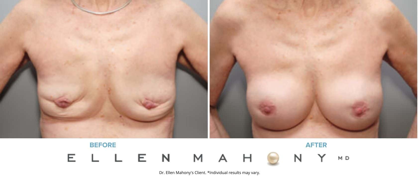 Corrective Breast Surgery | Westport CT | Dr. Ellen Mahony