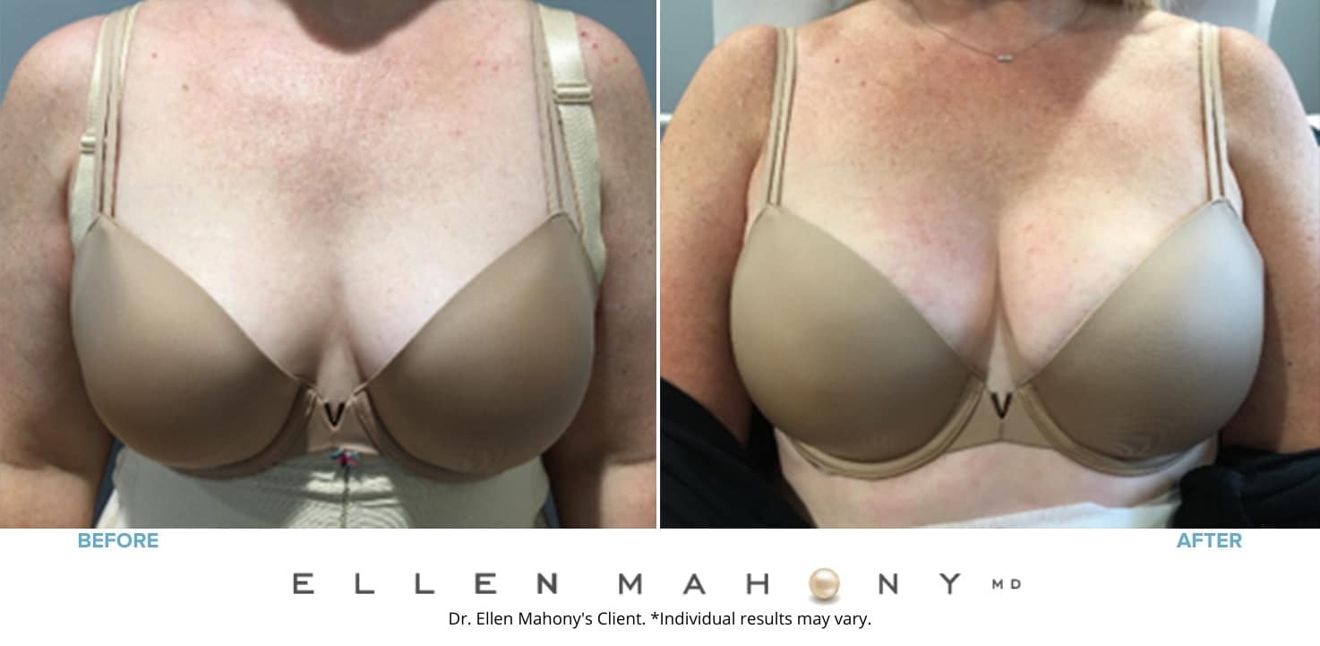 Woman’s chest in bra before and after vampire non-surgical facelift, chest fuller after procedure