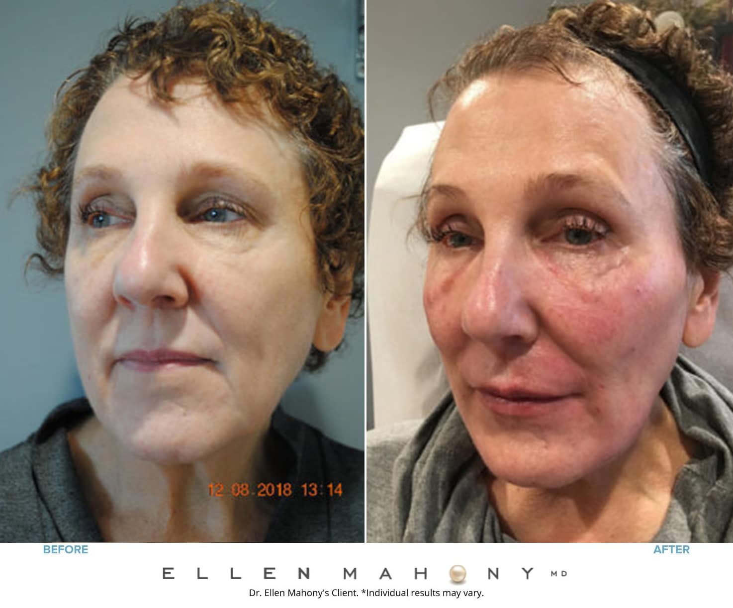 ALMI Regenerative Cell Facelift | Westport CT | Dr. Ellen Mahony