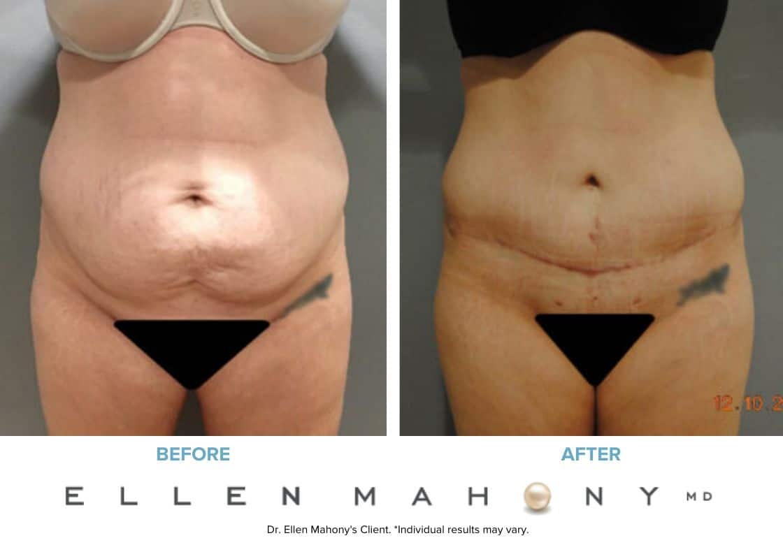 Tummy Tuck | Westport CT | Dr. Ellen Mahony