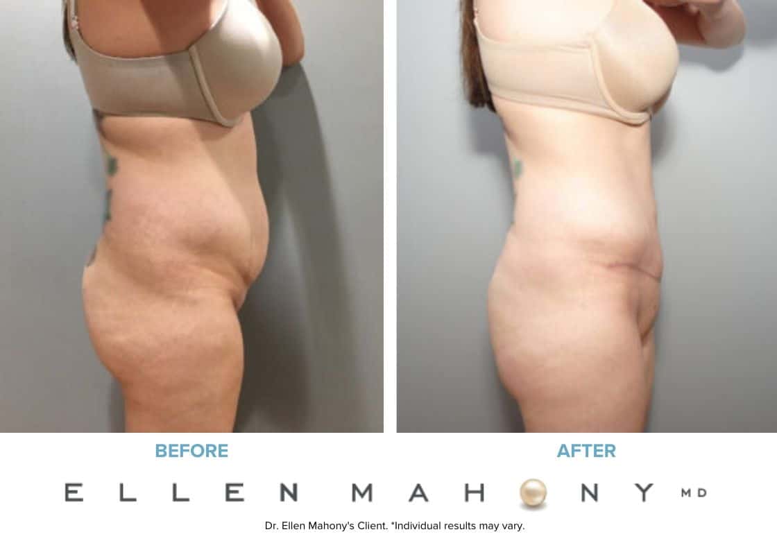 Tummy Tuck | Westport CT | Dr. Ellen Mahony