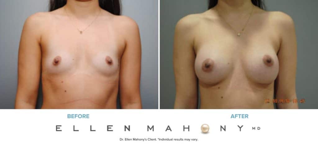 IDEAL Breast Implants | Breast Augmentation | Westport CT | Dr. Ellen Mahony