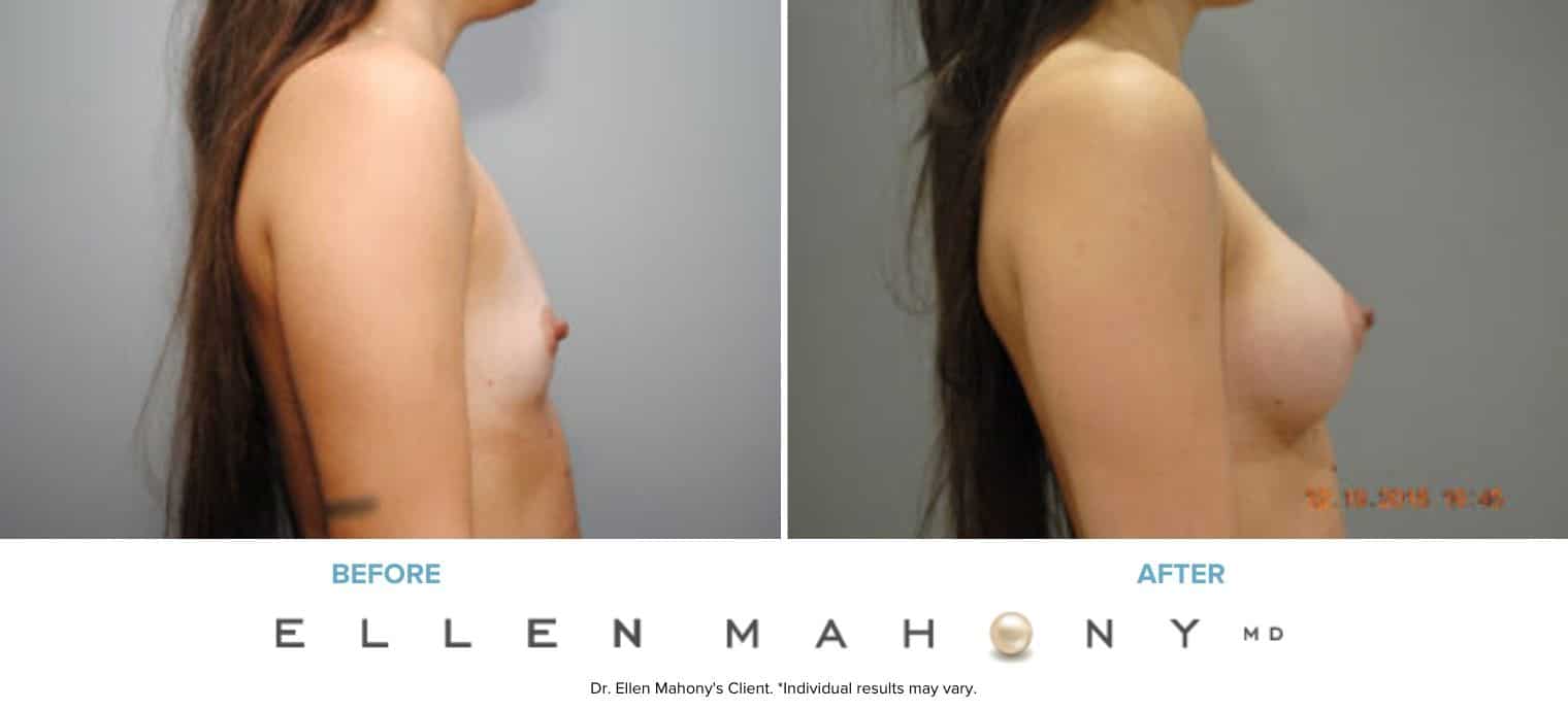 IDEAL Breast Implants | Breast Augmentation | Westport CT | Dr. Ellen Mahony