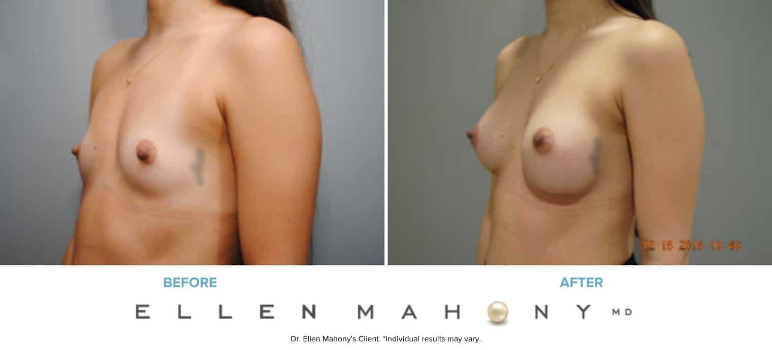 IDEAL Breast Implants | Breast Augmentation | Westport CT | Dr. Ellen Mahony