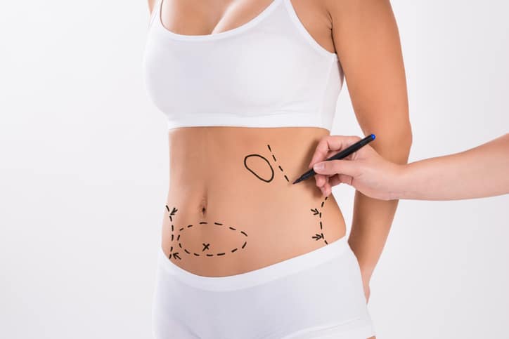 Dr. Trussler Liposuction