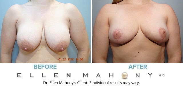 640px x 303px - Breast Procedures Archives - DrEllenMahony.com