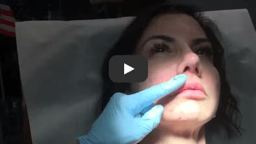 Lip Filler With Dr. Mahony