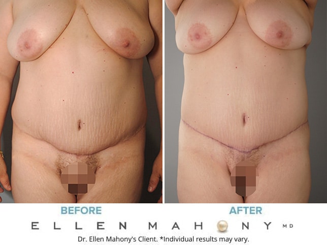 Before & After Image Monsplasty Westport CT