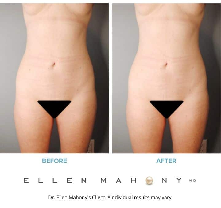 Before and After Image: Case #8436 - front