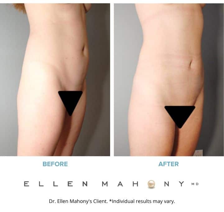 Before and After Image: Case #8436 - right-front-oblique