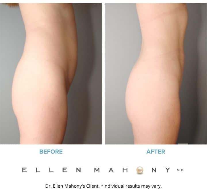 Before and After Image: Case #8436 - right-side