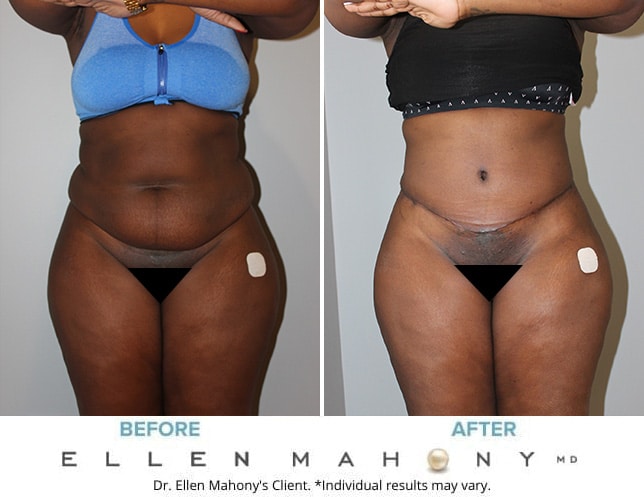 Lipo For Women Before & After NYC