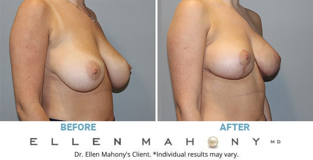 36a Natural Boobs - Breast Procedures Archives - DrEllenMahony.com