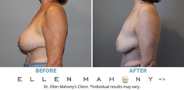 Breast Reduction and Lift -- 53 Years Young -- 38DDD to 36C (?) 